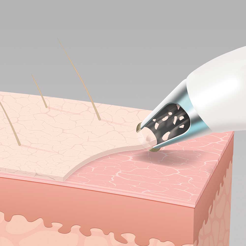 Radiance Microdermabrasion with Cooling