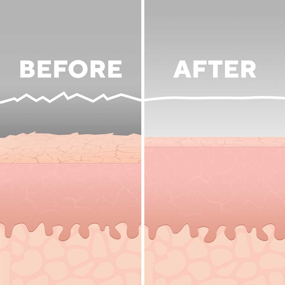 Radiance Microdermabrasion with Cooling